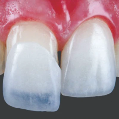 Lente de contato dental25