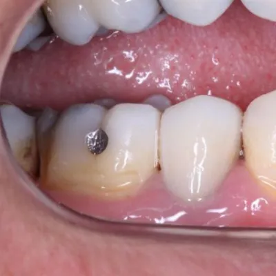 Prótese Fixas Imagem